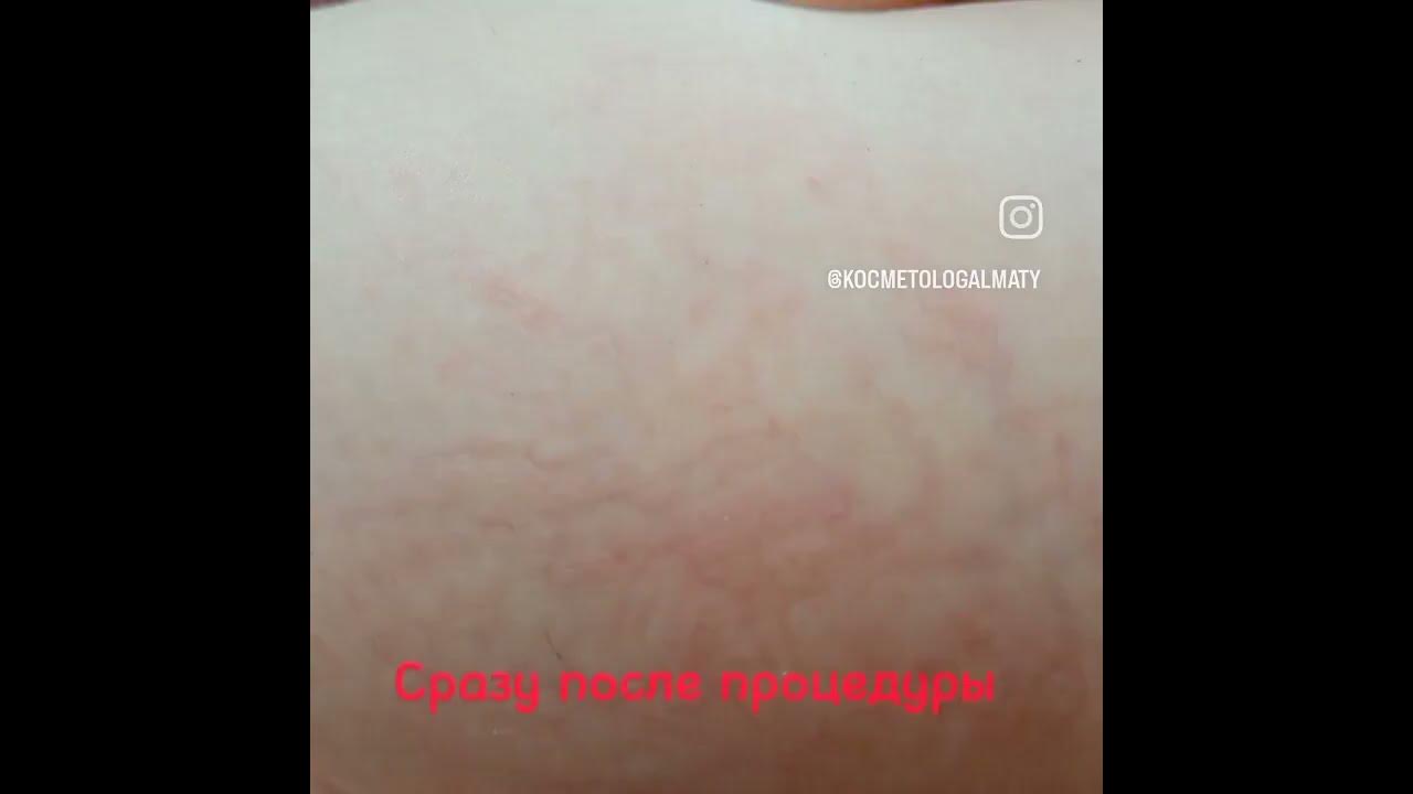 Удаление сосудистой сетки на лице и теле - YouTube