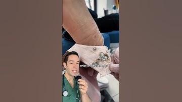 Doctor Reacts: extreme foot warts