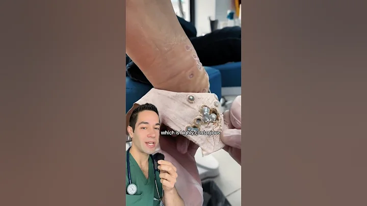 Doctor Reacts: extreme foot warts