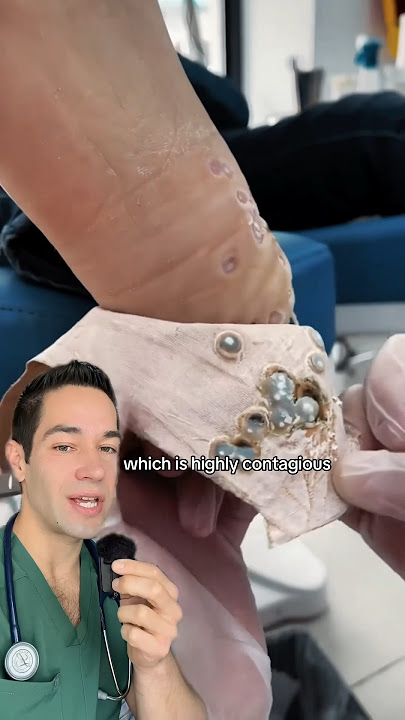 Doctor Reacts: extreme foot warts
