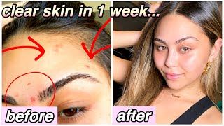 how I cleared my acne scars in 1 week *flawless glowy skin* | Roxette Arisa