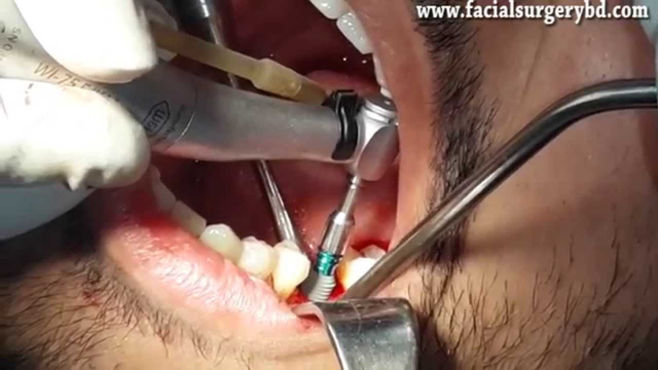 Dental Implant Surgery in Bangladesh Done by Dr Masud W / English