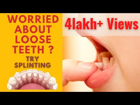 Treatment of Loose Teeth- Splinting |how to fix loose teeth part 2