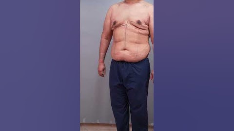 360° Abdomen Liposuction | Male Abdomen Liposuction result
