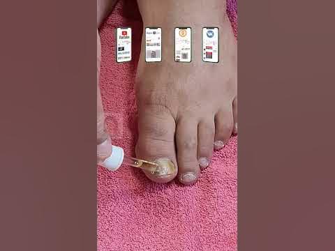 Как избавиться от грибка ногтя! Артикул 40255144 #грибокнаногах # ...