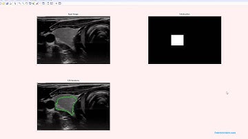 Segmentation of single thyroid image.