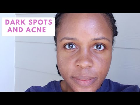 Skin Care Routine for Acne and Dark Spots using Generic Retin-A and Aczone