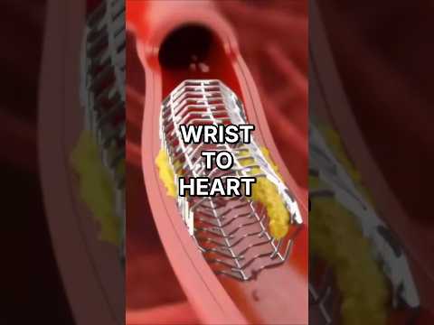 How Do Heart Stents Travel From Wrist To Heart