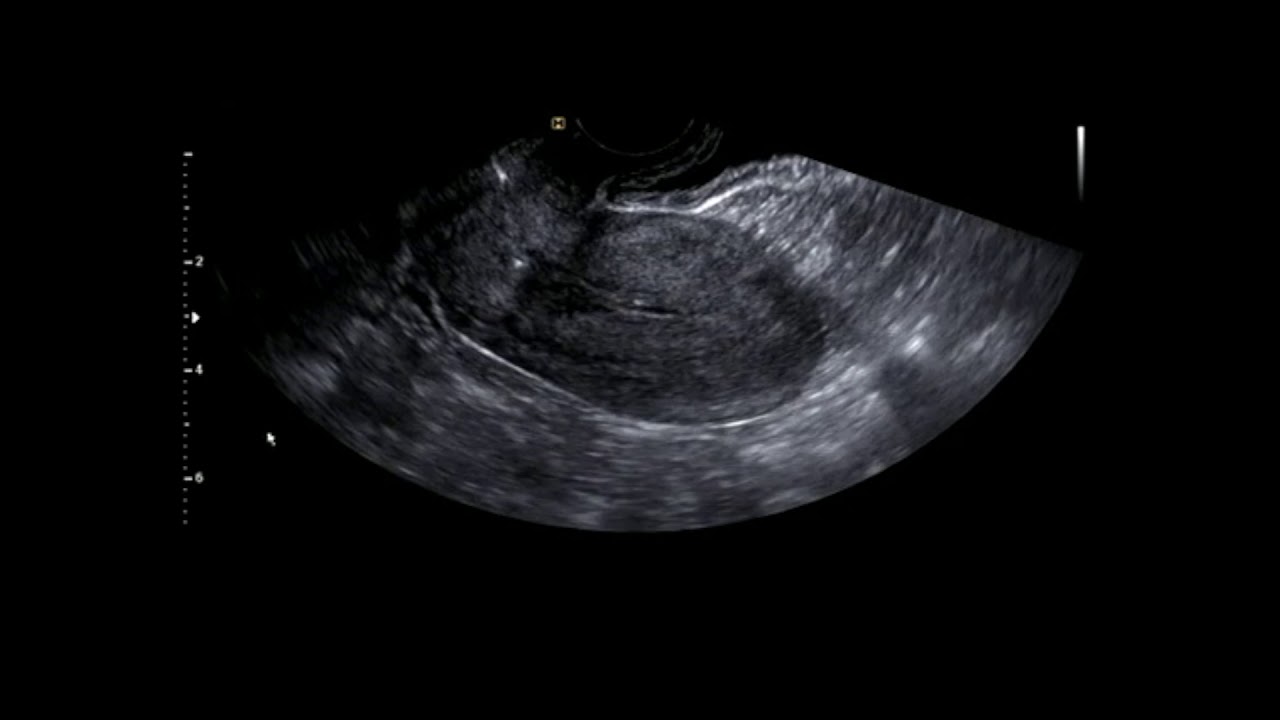정상 자궁과 난소의 초음파 동영상