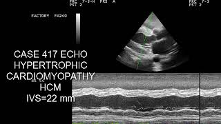 case 417 echo hypertrophic cardiomyopathy