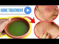 All Type of Allergies Treatment from Netural Herb | Allergie, Kharash, K...