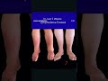 2 weeks of targeted lymphedema treatment. A combination of manual lymphatic drainage &amp; compression