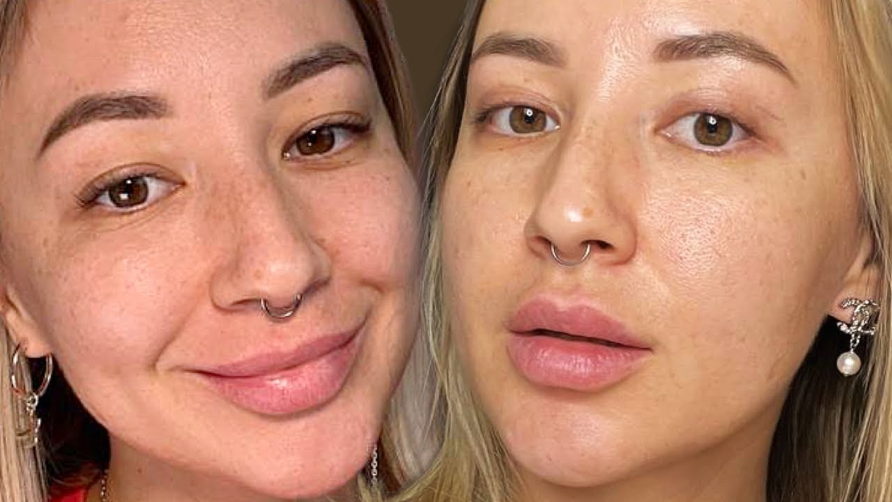 КАК ПРОШЛА МОЯ БЛЕФАРОПЛАСТИКА