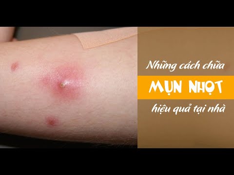 Cách trị mụn nhọt ở mặt tại nhà hiệu quả