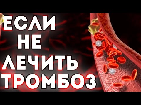 Чем опасен нелеченный тромбоз?