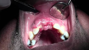 Bone Grafting #8-9 Sites, Mineross, Memlok, Cytoplast TXT d-PTFE, 1 week Post-op Visit
