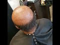 Alopecia client gets waves