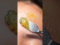 What Waxy Filaments Hide in Forehead Pores?