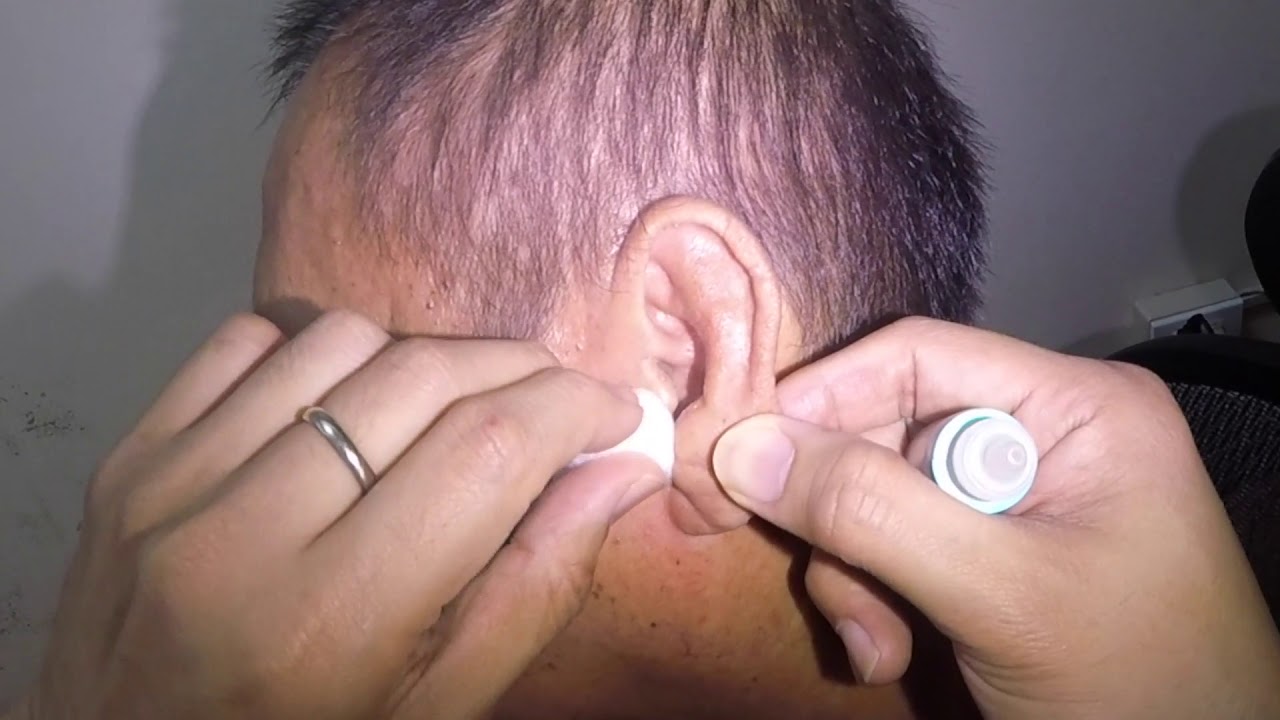 Elderly Man's Earwax Removed After Applying Earwax Softener YouTube