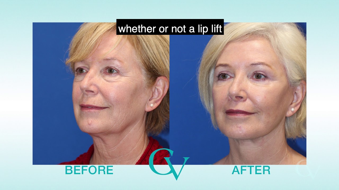 Lip Lift Procedure by Dr. Amir Karam YouTube