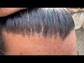 Hair Transplantation result 9 month | ഒരു ഗ്രാഫ്റ്റ് പറിച്ച് കളഞ്ഞു | safvan pullara Mp3 Song