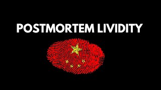postmortem lividity# #foreniscmedicine