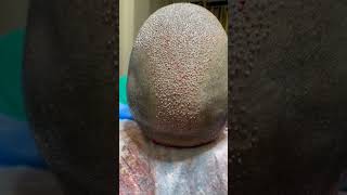 Showing  4500+ Graft Surgery Hair Transplant With High Density | Hair Transplant #shortvideo