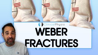 What is a Weber Ankle Fracture? | What they are, Key things to know, and How they are managed!