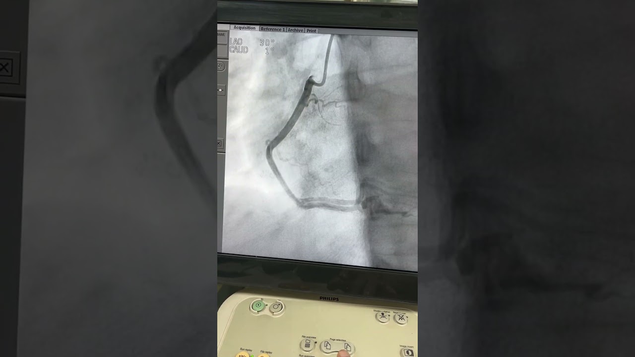 minor heart attack , coronary angiography showed no blockage but slow blood flow