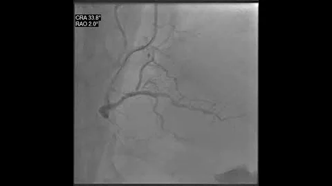 RCA – staged PCI 1