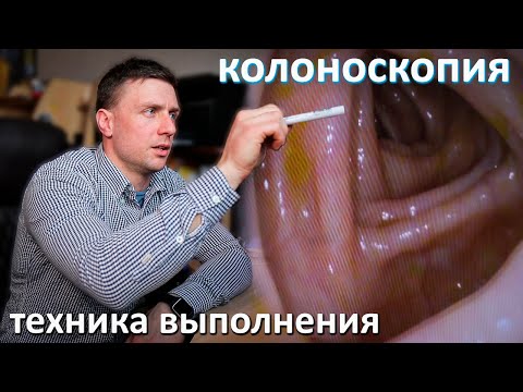 Колоноскопия без наркоза, техника выполнения. Разбор с эндоскопистом