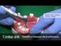 Dio Implant Dental Implant Education Video for Dentist