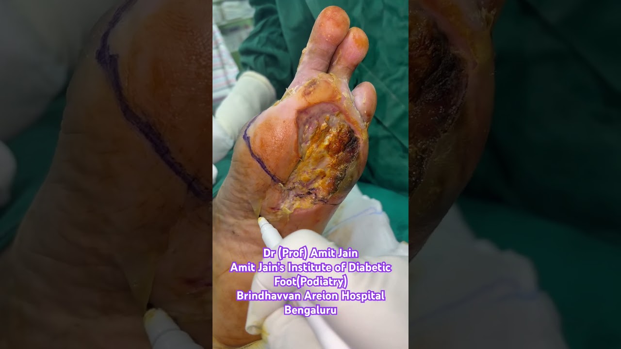 #diabeticfoot #amputation #ulcers #infection #smoker #woundcare |Best Podiatrist in Bengaluru #diabeticfoot #amputation #ulcers #infection #smoker #woundcare |Best Podiatrist in Bengaluru