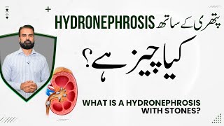 Hydronephrosis With Kidney Stone - Swelling of Kidney in Urdu | Pathri Ka Sath Hydronephrosis