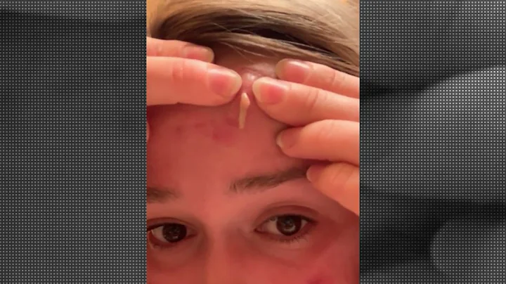 Aimee's Cystic Acne Demonstration