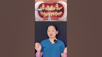 Đây đây! Đây chính là nguyên nhân tại sao răng khấp khểnh lên niềng răng! #viral #short #niengrang