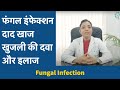 फंगल इंफेक्शन (Fungal Infection) दाद खाज खुजली की दवा और इलाज #daadkhajkhujli