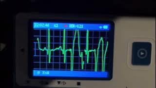 Irregular HeartBeat With Needle (Part 3)