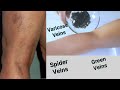 EASIEST WAY TO GET RID OF VARICOSE VEINS | GREEN VEINS AND SPIDER VEINS