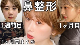 【鼻整形】ダウンタイム経過 1ヶ月まとめ🖤