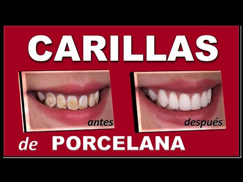 CARILLAS DENTALES CERAMICAS (PORCELANA) DURACION  E INDICACION