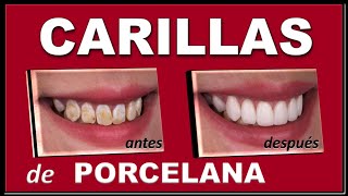 CARILLAS DENTALES CERAMICAS (PORCELANA) DURACION  E INDICACION