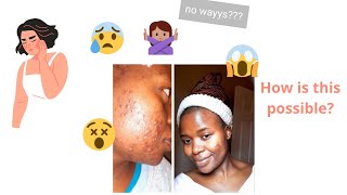 HOW IM GETTING RID OF DARK SPOTS