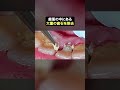 【歯石除去】見えないけれど歯茎の中にも歯石が潜んでます#ザホワイトデンタルクリニック #歯医者 #歯石除去