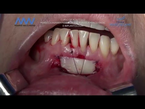 Que es la cirugia plastica periodontal
