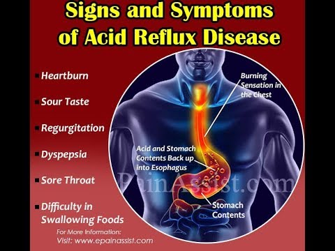 Acid reflux symptoms burning throat