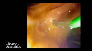 Management of bile duct leak in supine position using the Exalt single-use duodenoscope