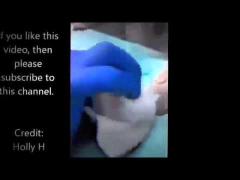 Sebaceous Cyst Treatment | Pulsing Ingrown Hair Removal kopia