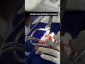 Tonsillectomy