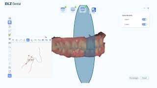 Intraoral Scanner Measurement Tool Using Guides